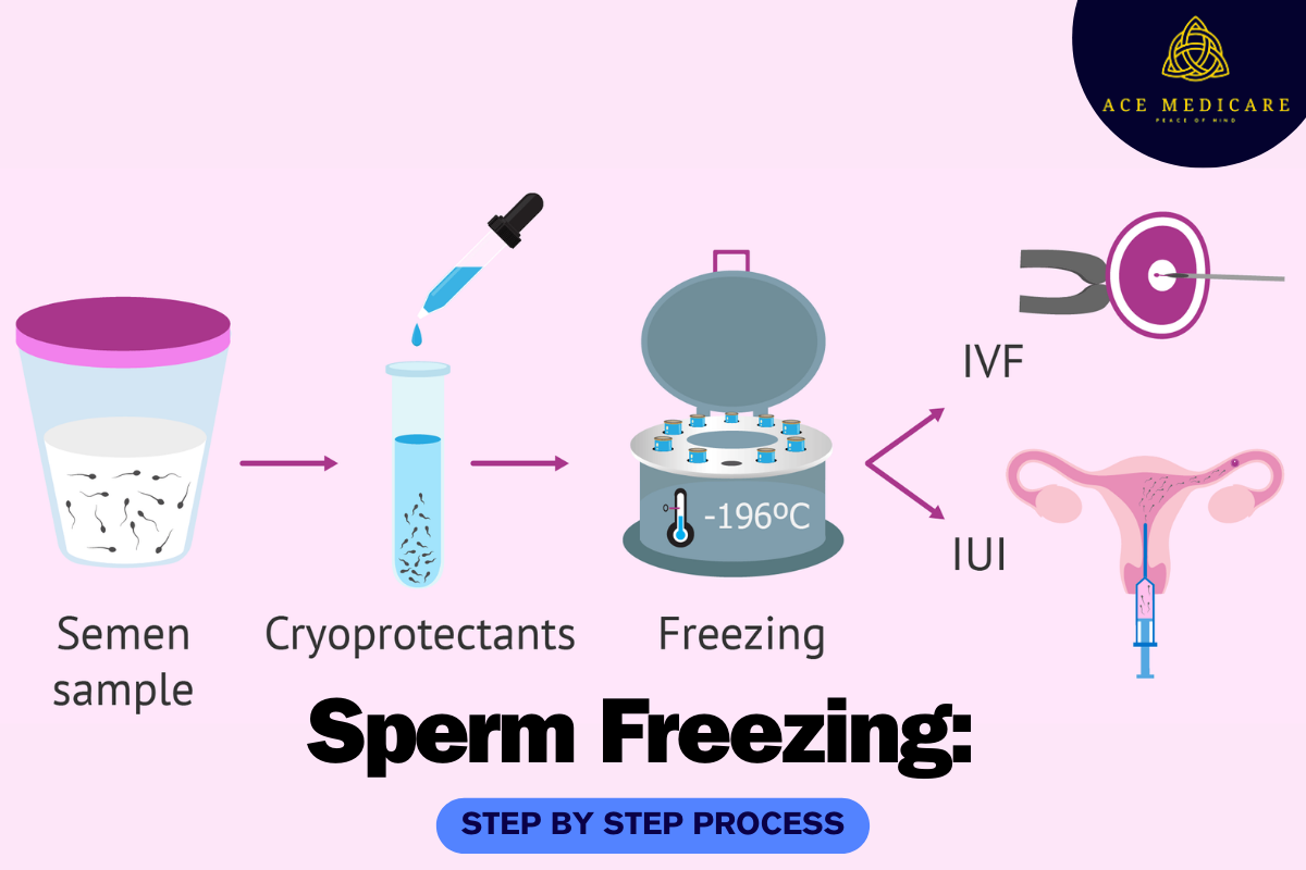 Sperm Freezing: Step by Step Process
